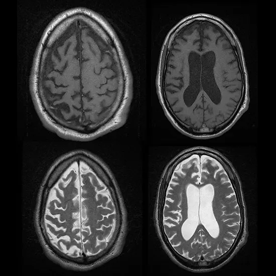 Gerstmann Straussler Scheinker Syndrome